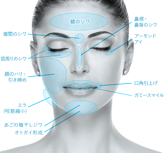 ボトックス注入箇所