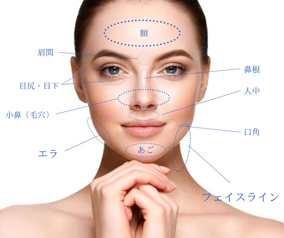 ボトックス注入箇所