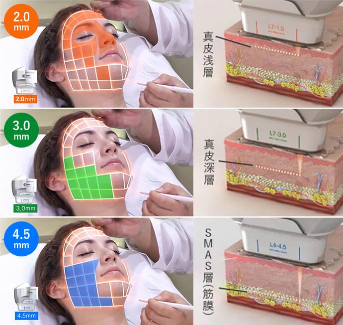 たるみ治療の様子
