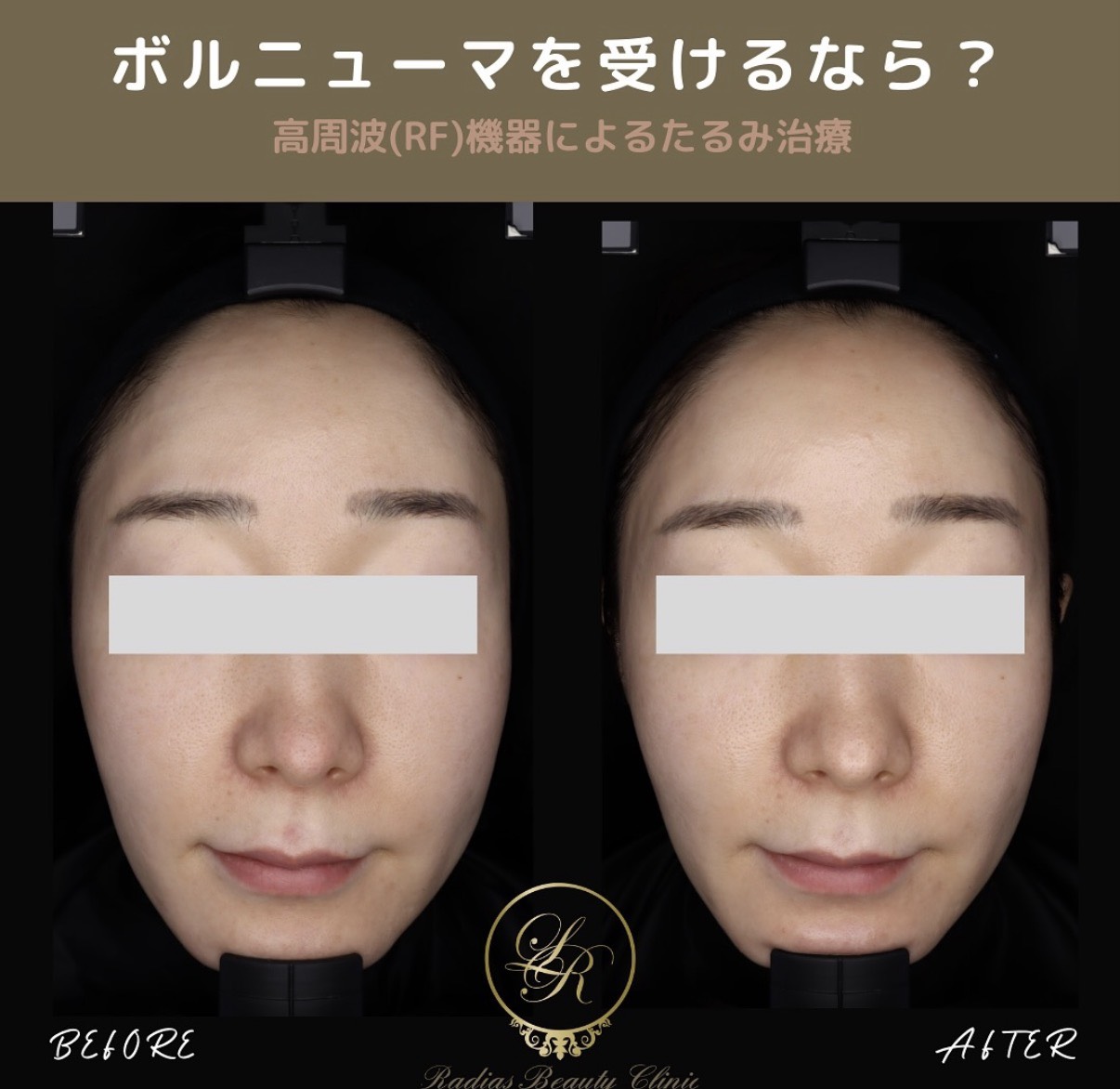 ボルニューマ | 症例写真