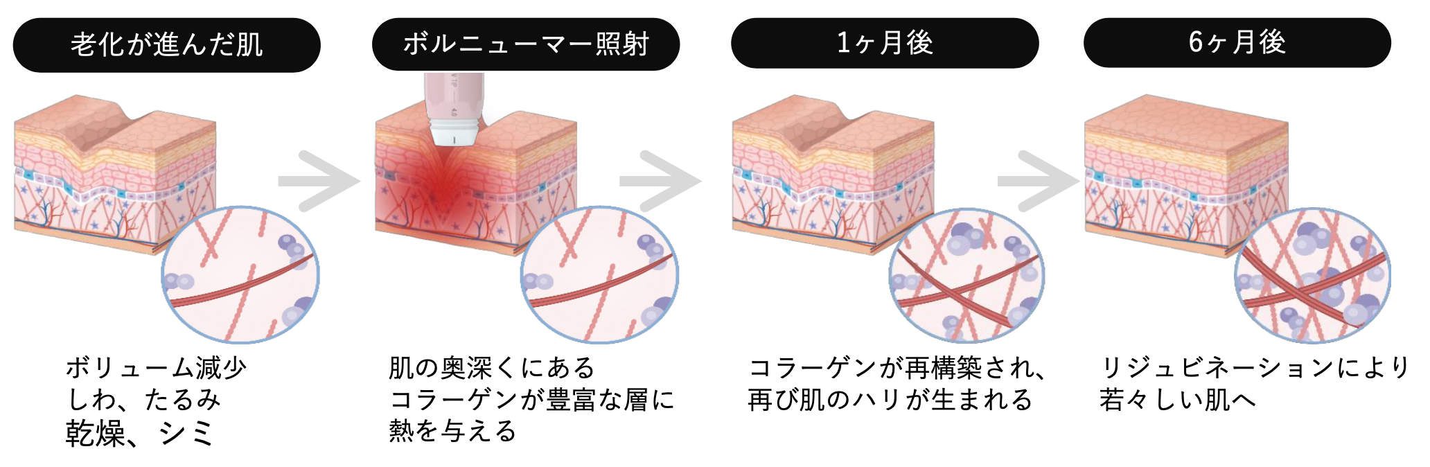 ボルニューマーによる治療のメカニズムのイメージ